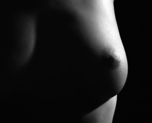 Weibliche Brust, Eigenfett transplantation nach Brustkrebs, cancer, kreks, mamma-carcinom