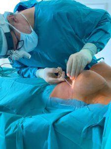 Einblicke in eine Brustvergrößerungs-Operation mit großen Implantaten – Volkhart Krekel zeigt hier seine Expertise. Das Bild verdeutlicht den präzisen und sorgfältigen Ablauf des Eingriffs.