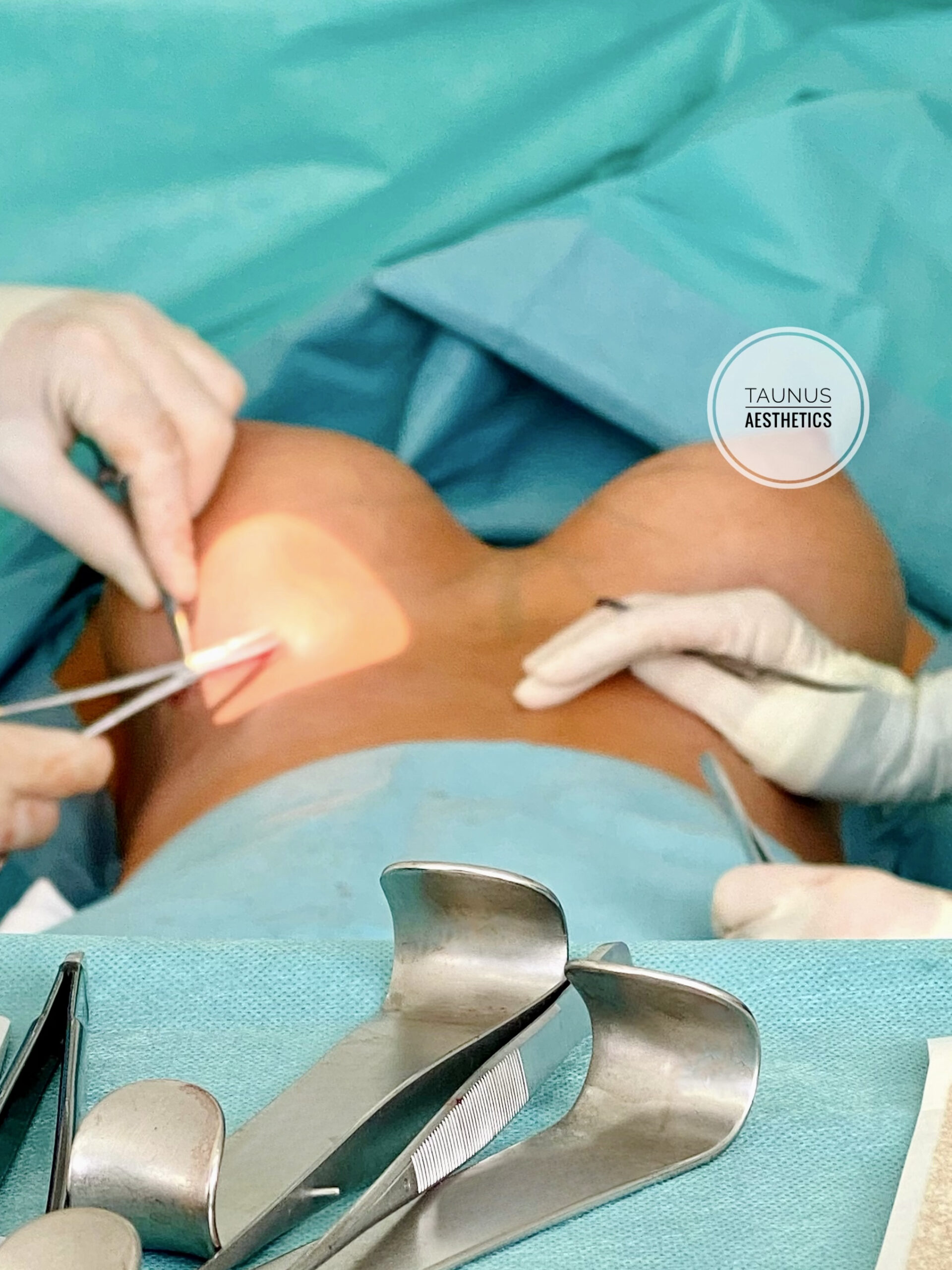 Zu sehen ist ein Operationstisch während einer Brustvergrößerung mit großen Implantaten
