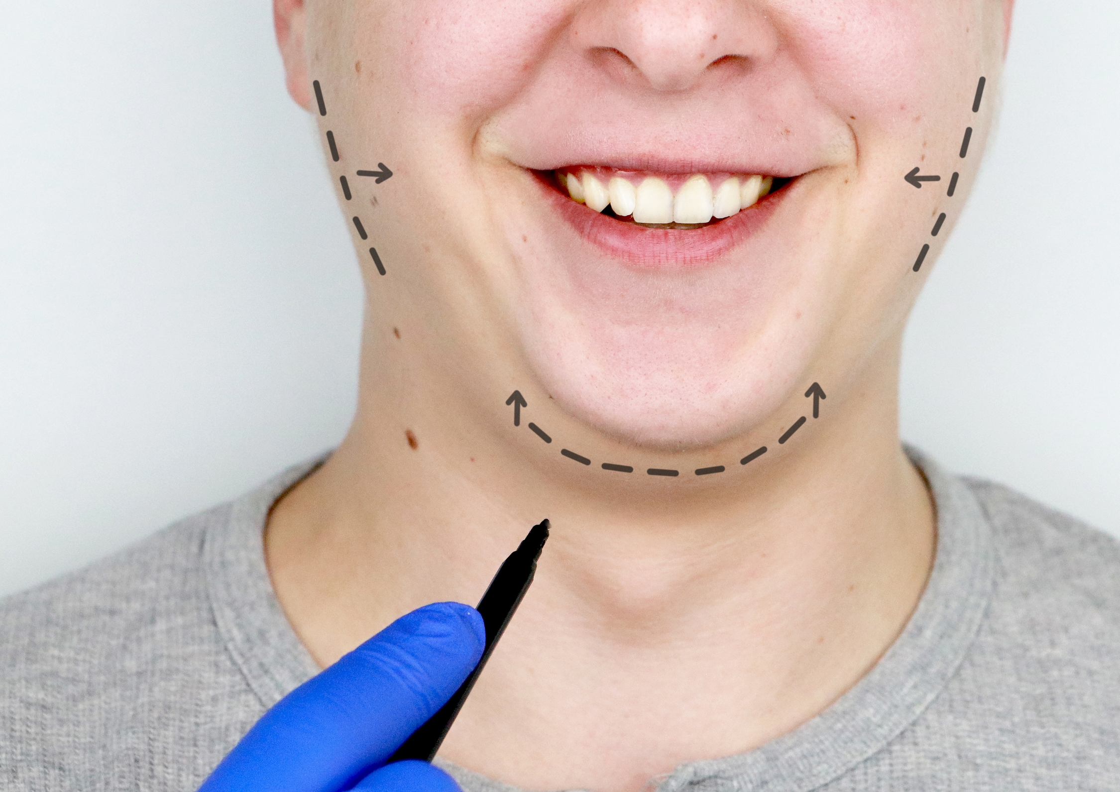 Männliches Gesicht mit Anzeichnenden für eine mögliche Operation z.B Bichektomie