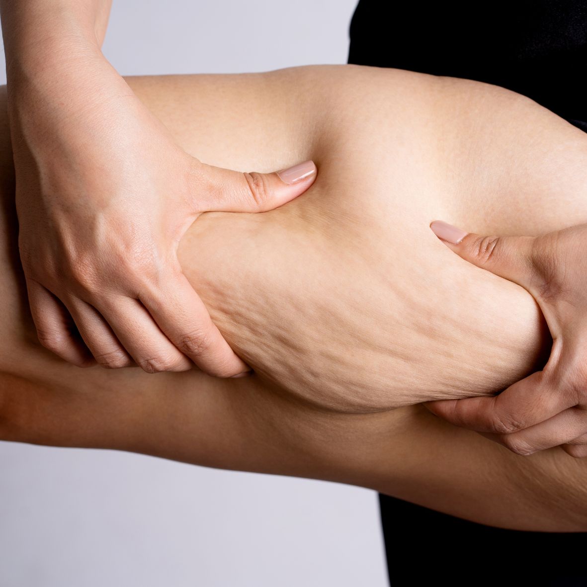 Eine Person kneift die Haut des Oberschenkels zusammen, man sieht etwas Cellulite an Ihren Beinen.