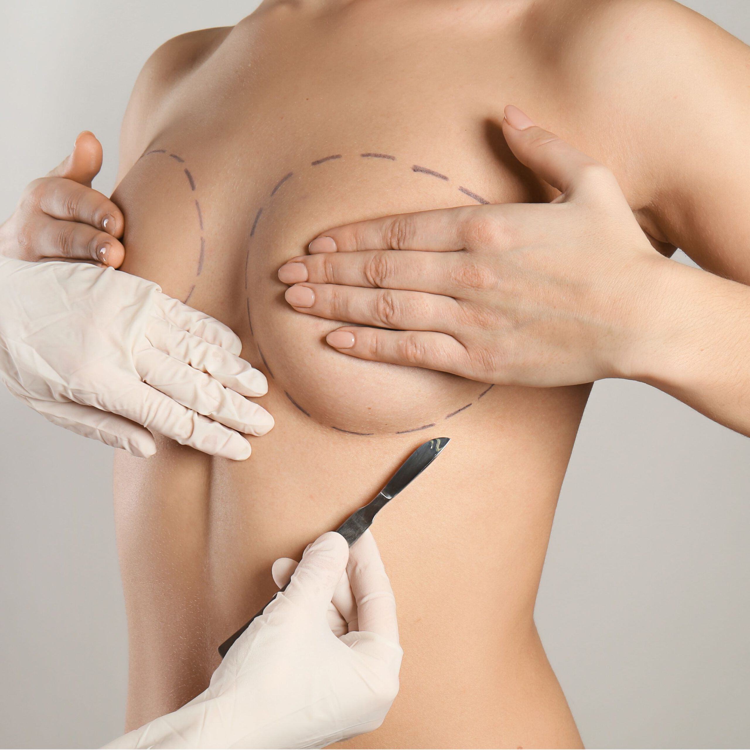 Eine Frau verdeckt ihre Brüste mit den Händen. Vor ihr sind die Hände eines Arztes zu sehen, die an der Brust eine Markierung für die spätere Implantatposition setzen.