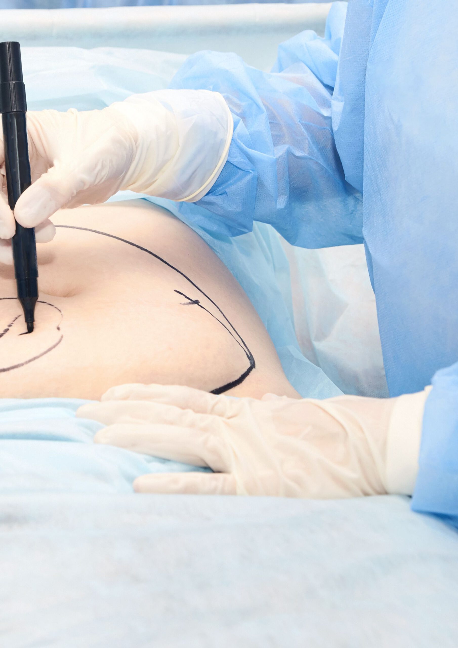 Bauchdeckenstraffung Ein Arzt zeichnet die Markierung für eine Bauchdeckenstraffung ein. Der Patient liegt auf dem Operationstisch. Der Arzt ist steril gekleidet und macht sich bereit für eine Operation.