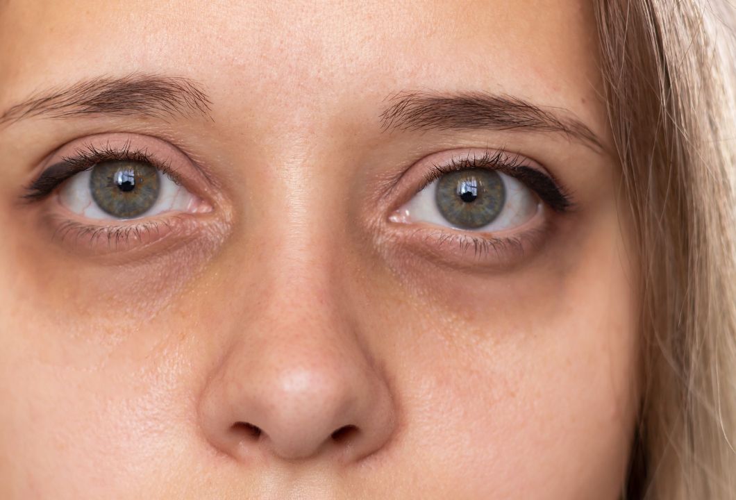 Frau mit stark ausgeprägten Augenringen und extremer Verdunklung der Haut unter den Augen